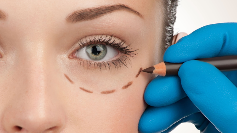 Blefaroplastia